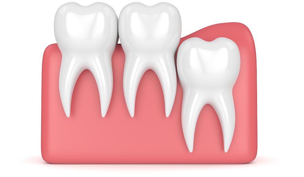 Implant dentaire Lyon : est ce que l’opération a des points négatifs ?
