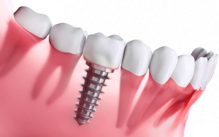 Prix Implant Dentaire Clinique Du Parc Lyon