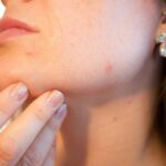 Utiliser le CBD pour lutter contre l’acné
